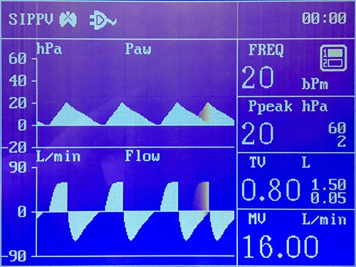 One Vaporizer Anesthesia System of ICU & Emergency Factory Supply Hospital Ventilator