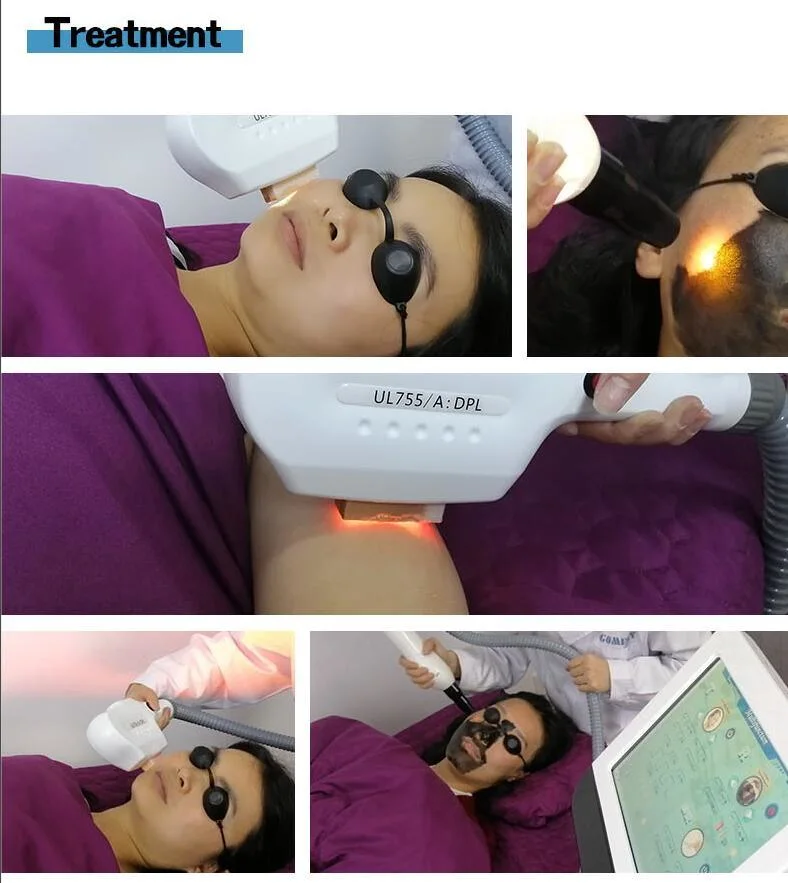 Pele Beleza Dpl Gomecy embranquecimento de fotões Máquina Dpl Laser de rejuvenescimento da pele