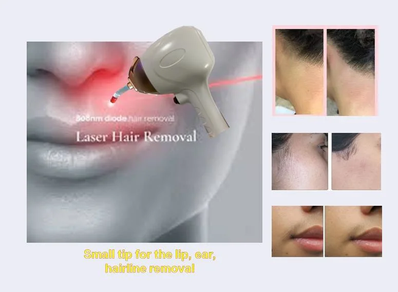 Laser Hair Removal Machine Diode Laser Hair Removal 755nm 808nm 1064nm Diode Laser Hair Removal Machine Price