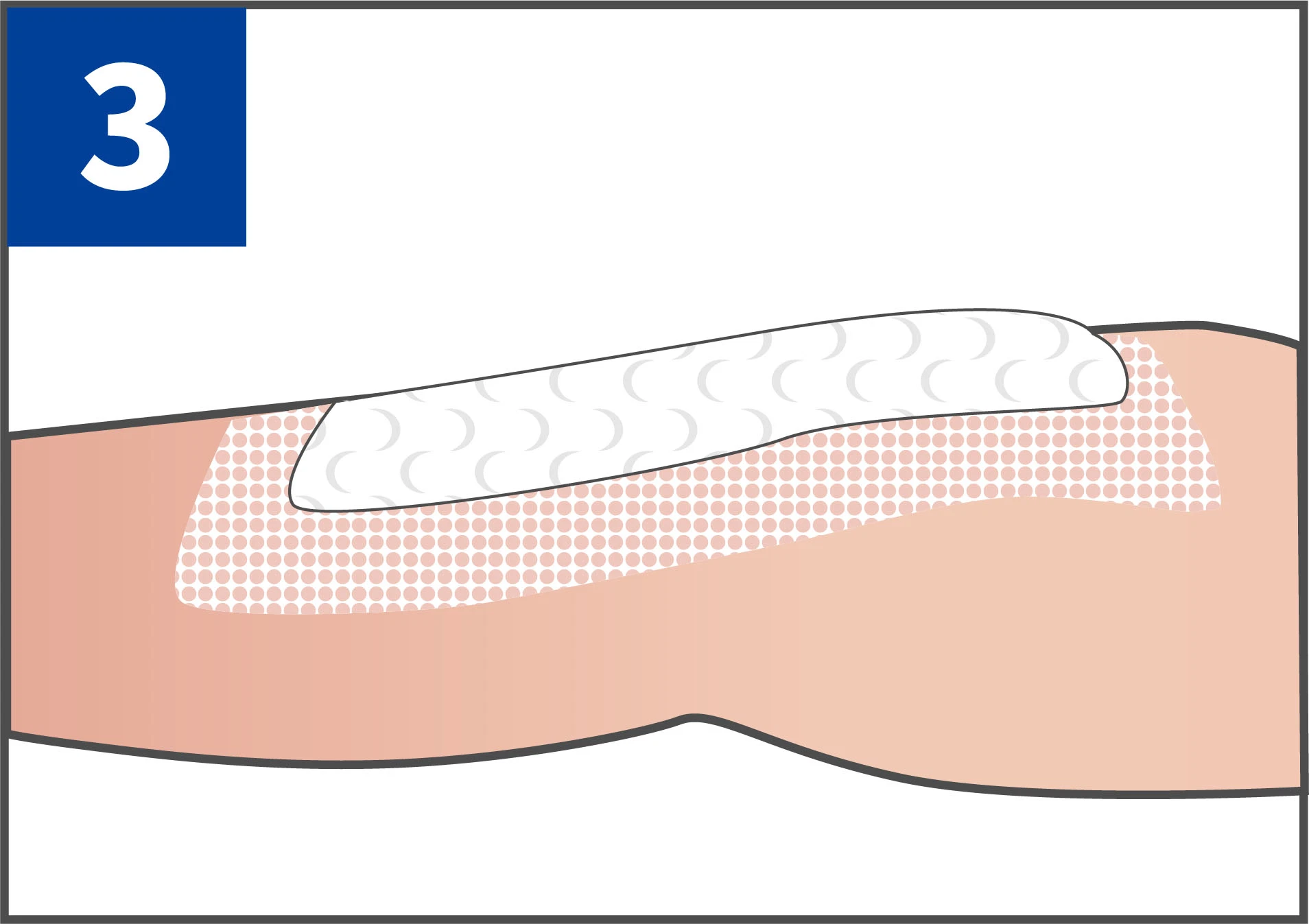 Transparent and Visible Medical Disposable Silicone Post-Operation Dressing for Diabetic Foot Ulcers