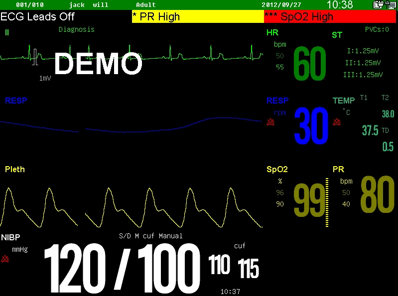 Sinnor SNP9000t manipulés Hospital Medical produits avec l'ECG de la pression artérielle oxymètre de pouls directement en usine