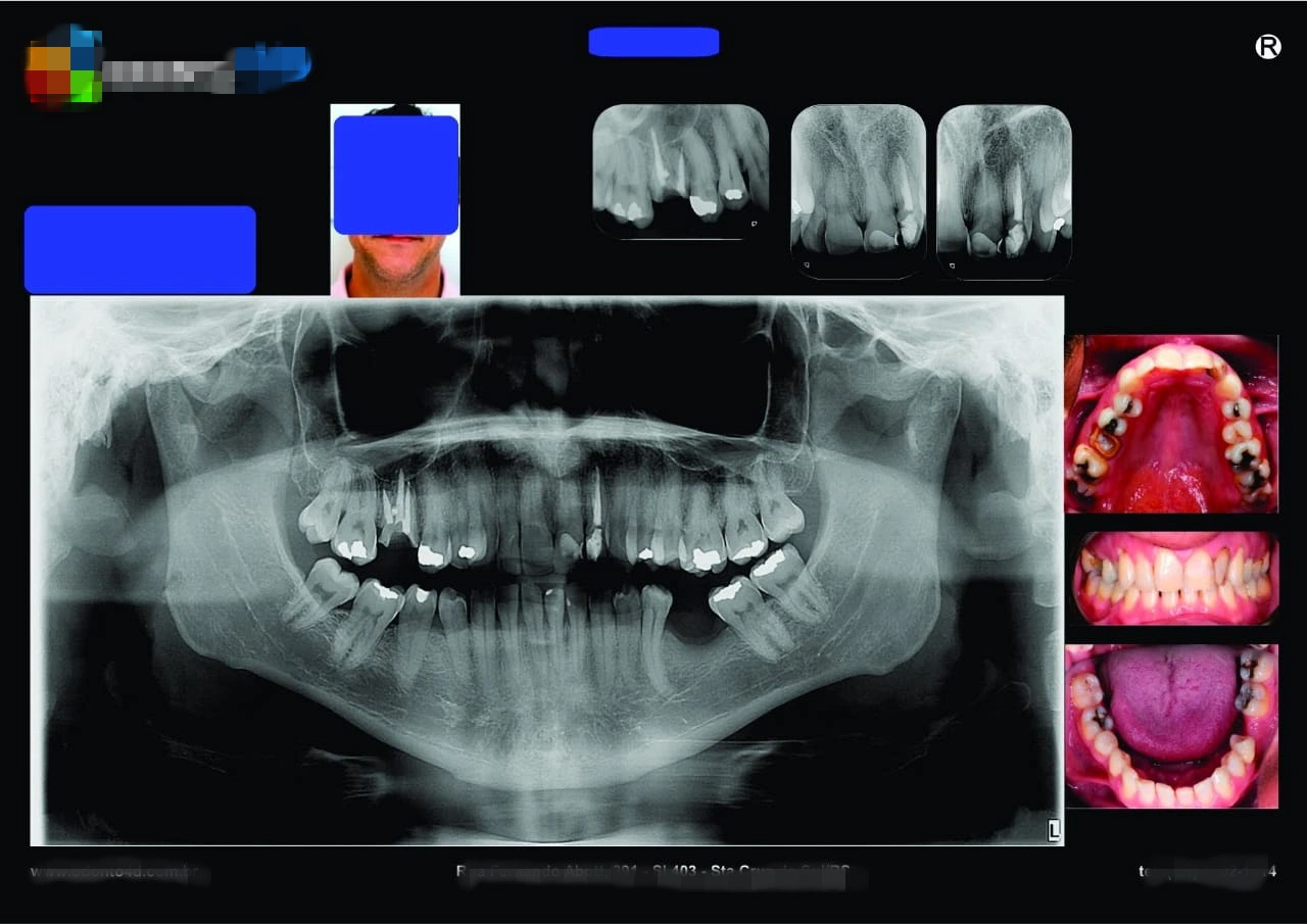 Lyd Digital Dental X-Rays Films for Hospital Cr Dr Medical X-ray Film Dry Blue Medical Film 8*10