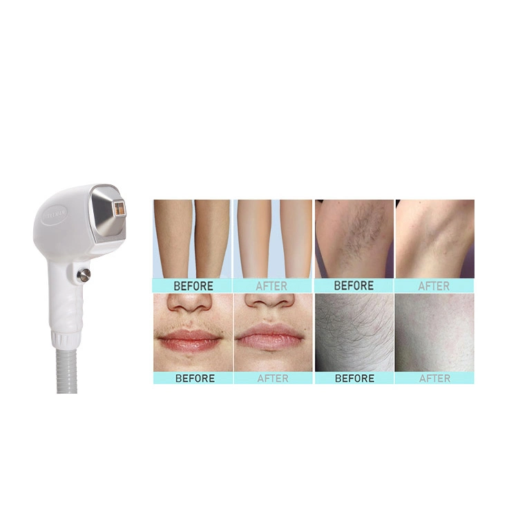 808nm en 1 máquina láser 4 Diodo láser + Tattoo Remoción ND YAG Laser + DPL Hair Removal + RF Máquina de Belleza