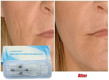 Cross Linked Hyaluronic Acid Dermal Filler for Correcting Facial Defects