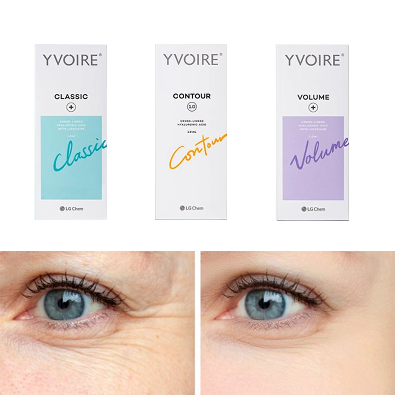 Yvoire Classic / Volume / Contour Injection Modified Sodium Hyaluronate Gel Hyaluronic Acid Dermal Filler Yvoire Neuramis Rejeunesse Dermal Filler