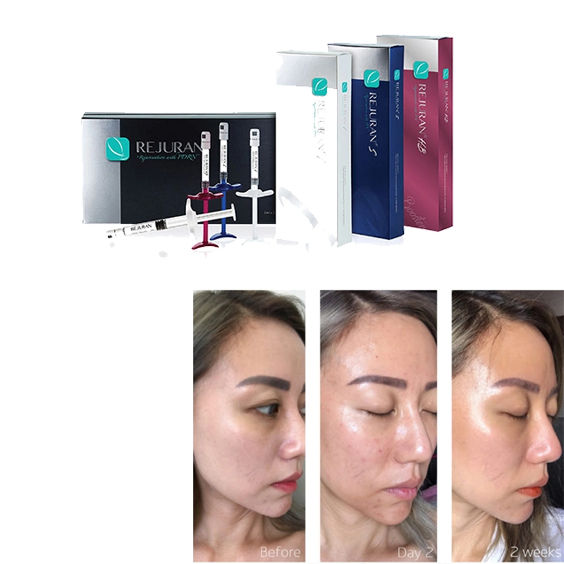 Rejuran Healer der niedrigste Preis in der Geschichte. Korea Dermal Filler Lachs DNA Prrn Therapie Wunderheilmittel Injektion