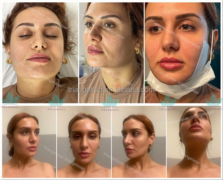 2024 Liposis facial de endurecimiento de la piel con láser de fibra óptica profesional más reciente 980nm Laser Doble Chin máquina láser de plástico