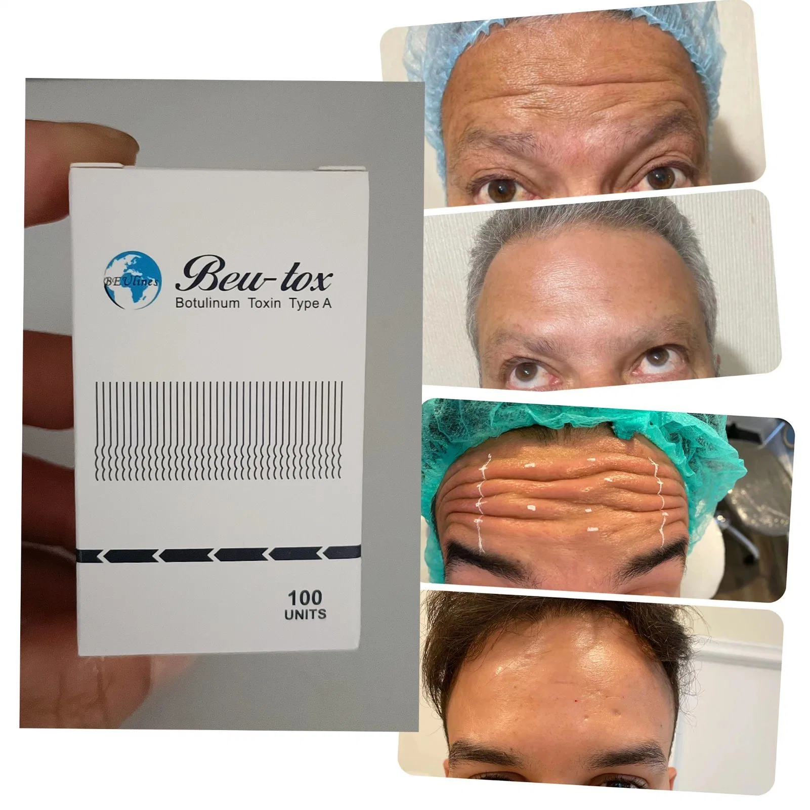 50UI 100UI 150UI de toxina botulínica Refinex Disport Otesali Injeção para enrugar Anti-Wrinkle face a toxina do músculo liso de elevação do depósito dérmico