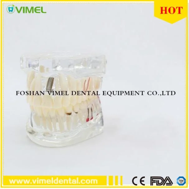 Dental Study Tooth Transparent Pathological Teeth Model for Adult Teaching