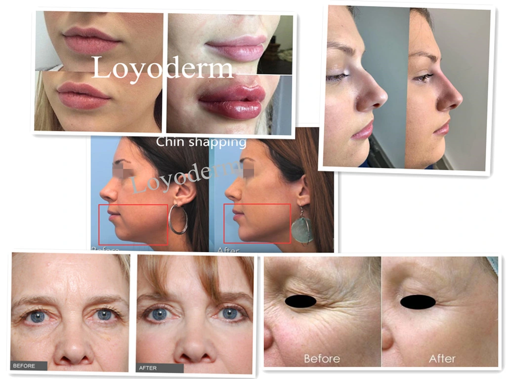 Cross Linked Injectable Dermal Filler for Ha Hyaluronic Acid Long Lasting Anti-Aging