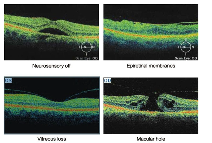 Ophthalmic معدات أكتوبر التماسك البصري Tomography MCE- Ose-2000