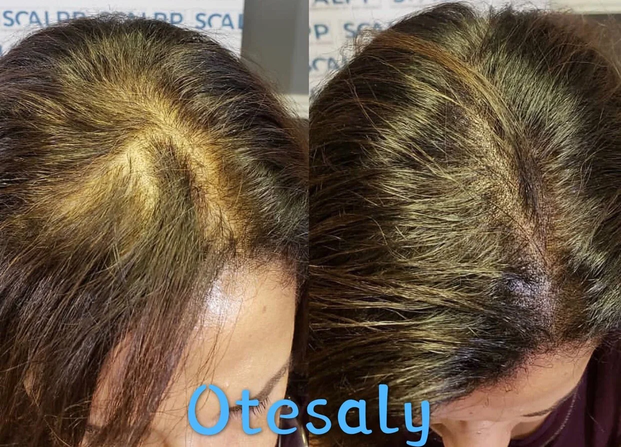 Haircare crecimiento del cabello Inyección Otesaly Anti pérdida del cabello Mesoterapia solución