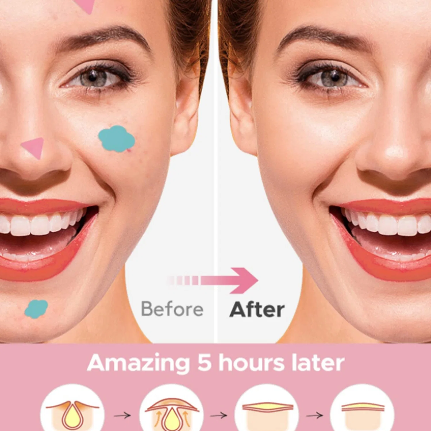 Zit Patches - Invisible Ultra Thin Spot Cover Stickers for Face and Skin