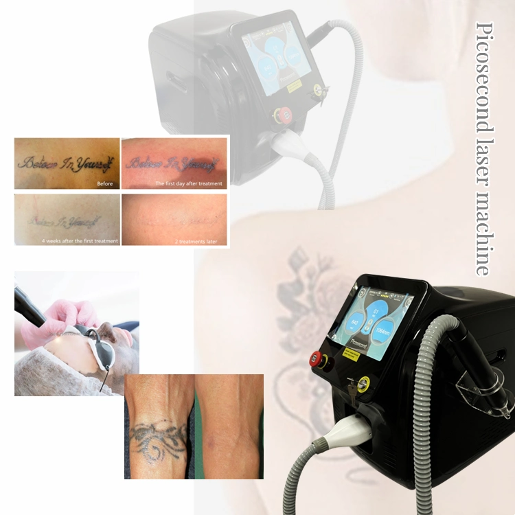 Appareil portable non invasif 755nm Pico laser Treatment tatouage au laser Picoseconde Machine d'élimination des lentilles pigmentaires Picoseconde Picopage d'élimination des mélasmes au laser Pico Laser