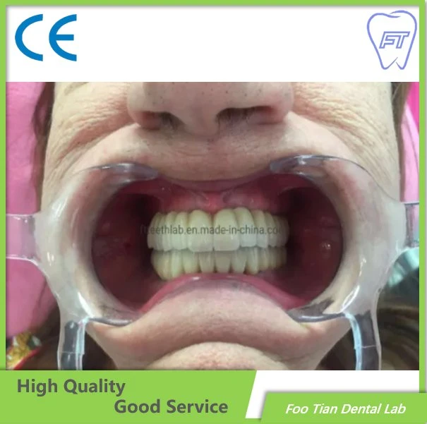 Traitement dentaire couronne en céramique de métal dentaire faite dans foo Tian Dental Lab à Shenzhen en Chine