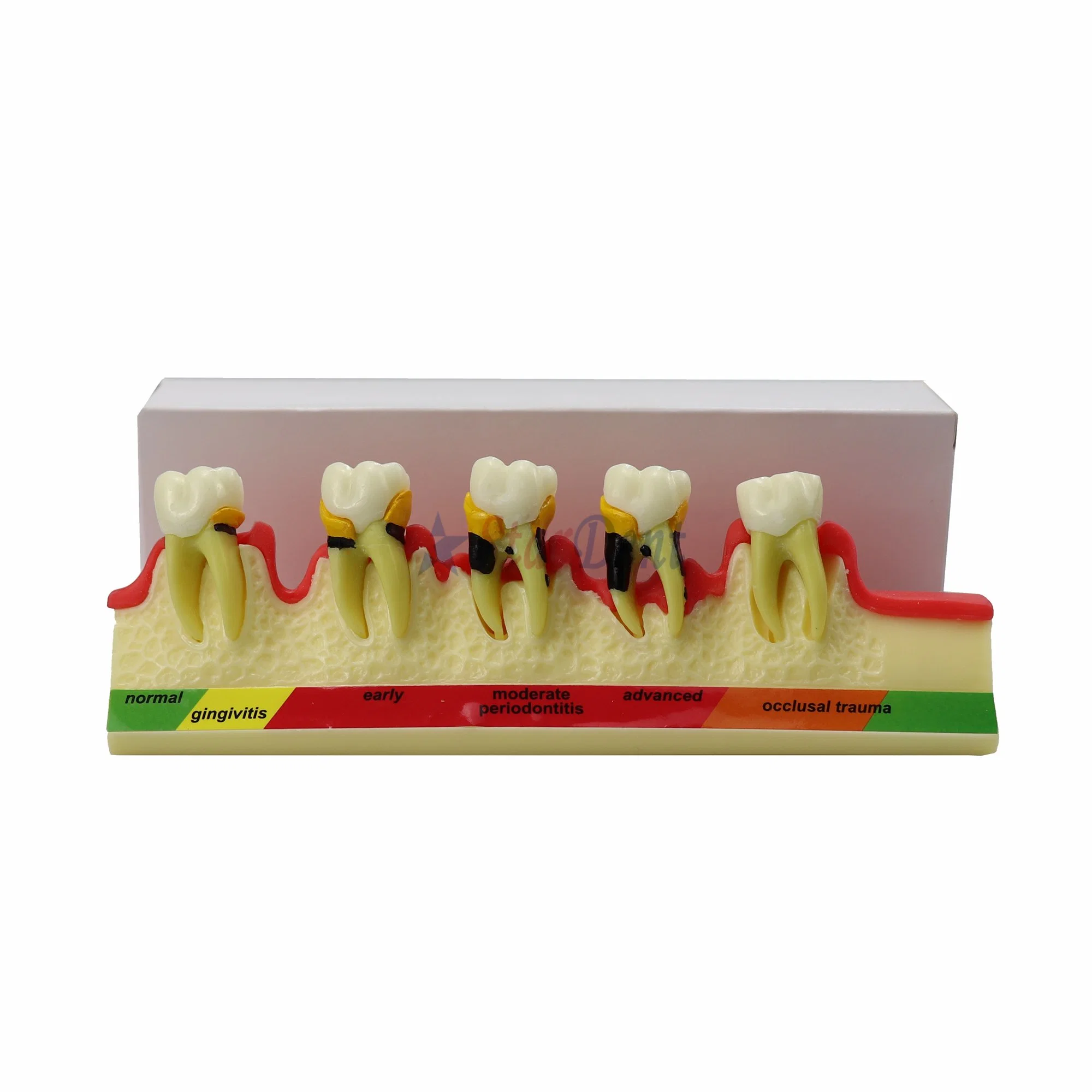 Dental Periodontal Disease Model Demonstrates The Progress of Periodontal Disease Dental Resin Teeth for Teaching