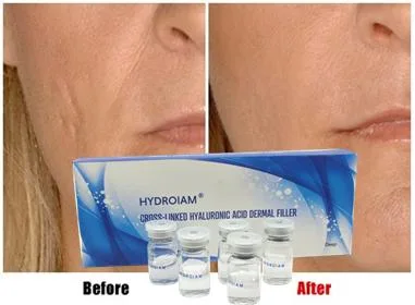 Injection Hyaluronic Acid Dermal Filler Anti-Aging Wrinkles