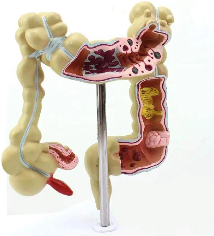 High quality/High cost performance  Medical Diseases Colon Model