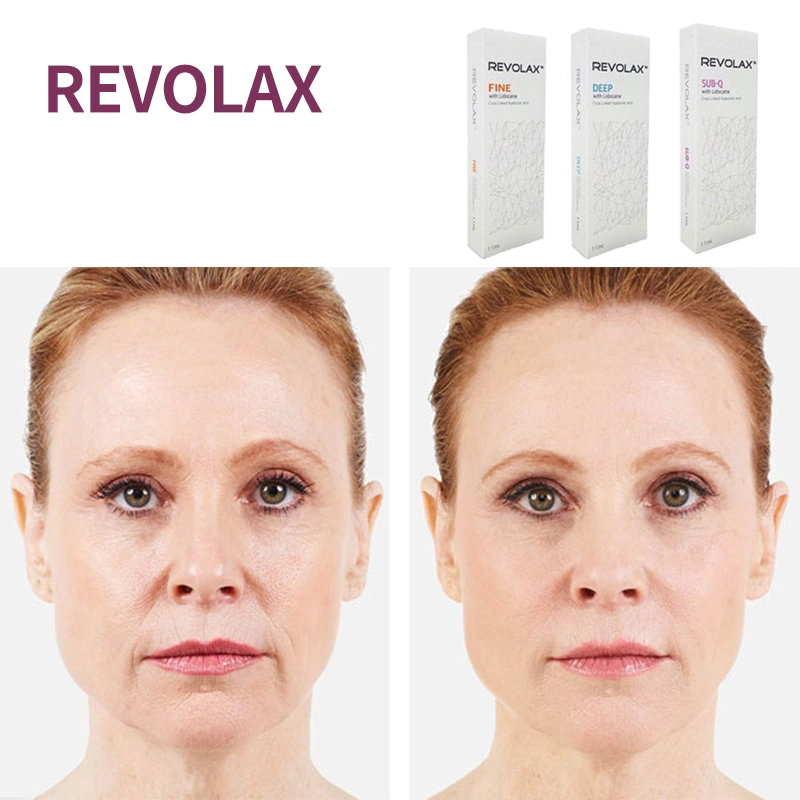 High quality/High cost performance Revolax Fine Deep Volume 1ml Hyaluronic Acid Injectable Dermal Filler Lip Filler Nose Chin Cheek Filling