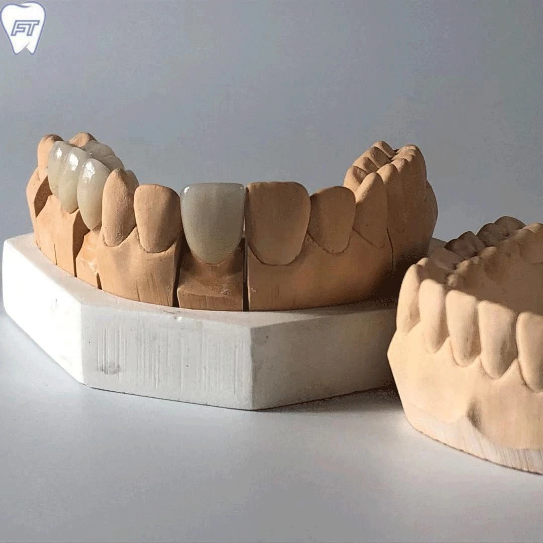 Matériel dentaire laboratoire laboratoire dentaire Implant Bruxzir personnalisé couronnes et de zirconium pont solide de la Chine Dental Lab