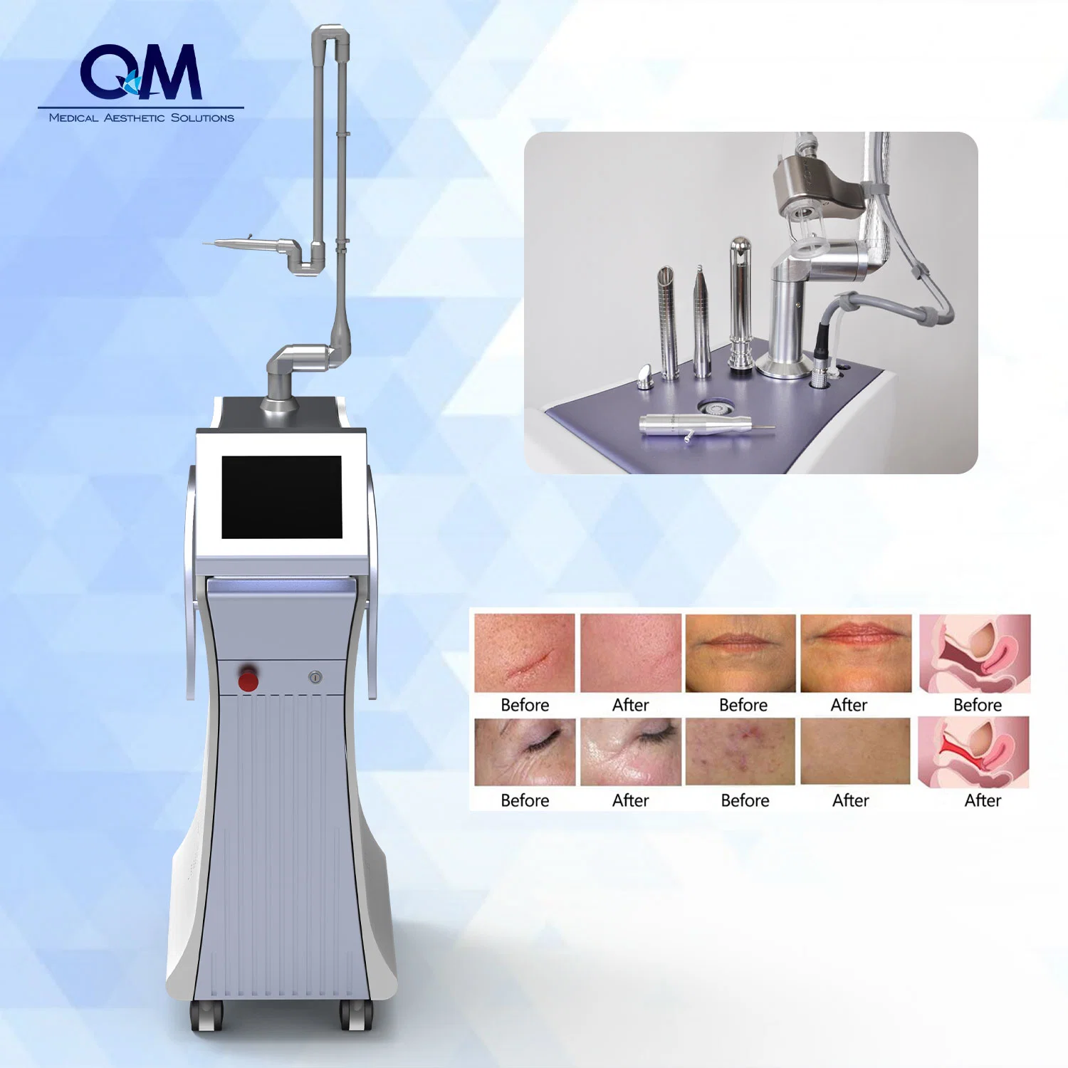 Лазерная CO2 Долевое восстановление кожи RF Metal Tube Medical Acne Удаление рубцов CO2 дробный лазерный вагинальный станок для подтягивании