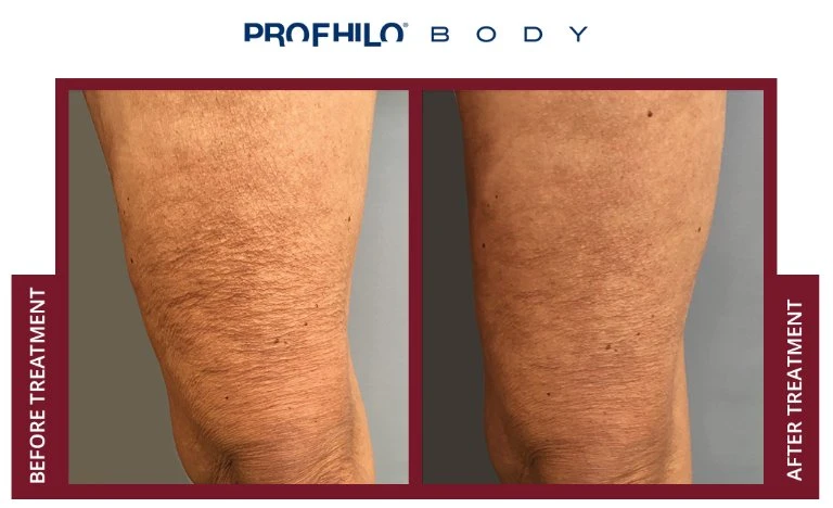 Profhilo for Body Profhilo Body Rejuvenates The Skin Without Adding Volume Like Other Types of Fillers. The Skin Is Actually Restored, Skin Sagging Is Addressed