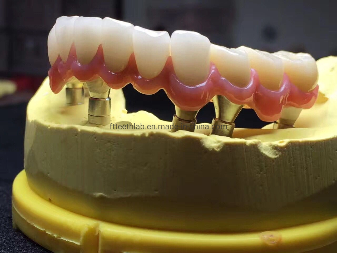 Стоматологические материалы имплантат расходных материалов на всех - 6 полный контур обедненной смеси верхнего стоматологической имплантации мост