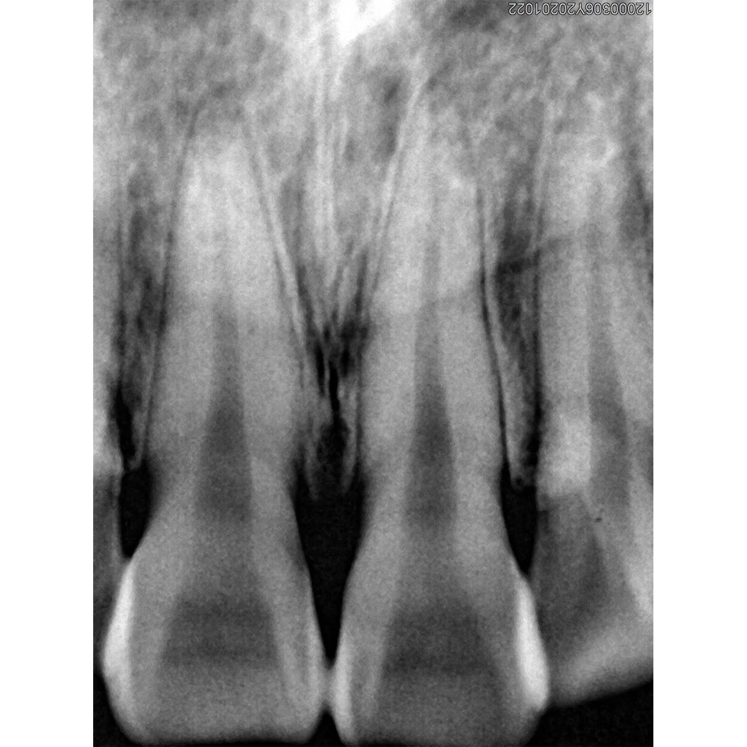 Sensor Digital Dental RVG, buena imagen USB Dental X Ray sensor Ruyes