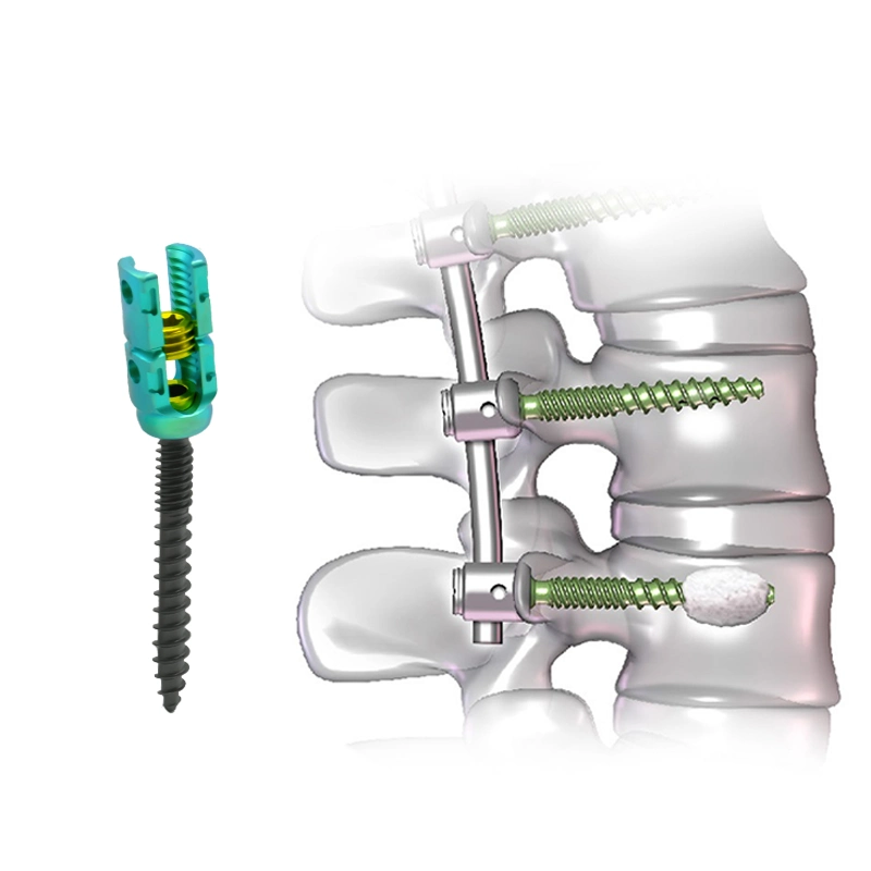 Hot Sell Orthgmarmargical Implantsplantات 5.5 برغي تقليل التيتانيوم للعمود الفقري المتعدد المحاور