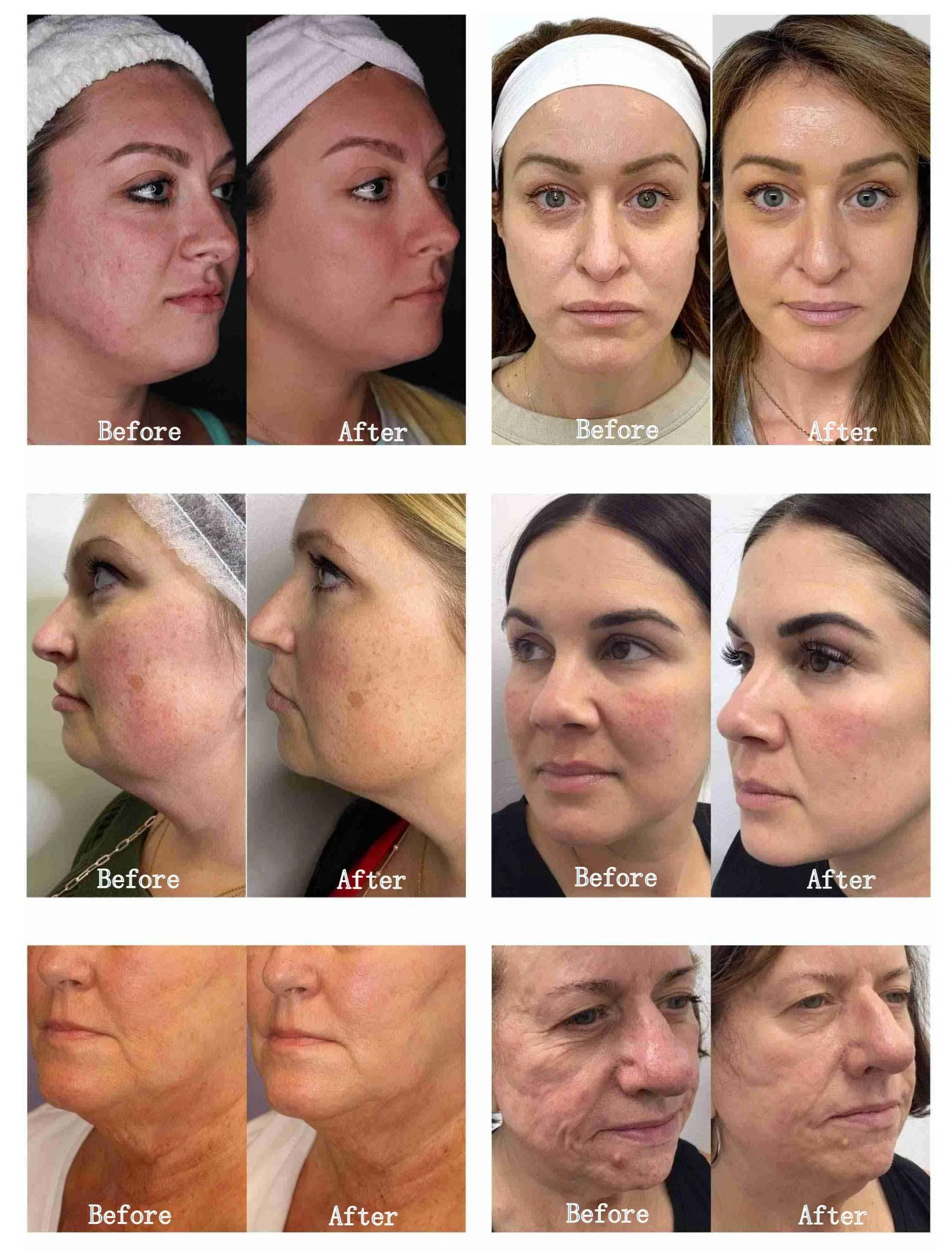 Mejorar sangre Roja cuerpo cara elevación frente piel arrugas Análisis RF Microneedling