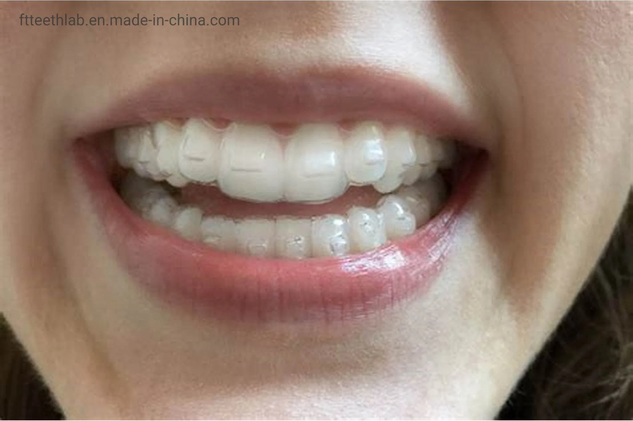 Unsichtbare orthodontische Tabletts hergestellt in China Dental Lab aus Shenzhen China, Die Ihre Unebenen Zähne Ausrichten Können