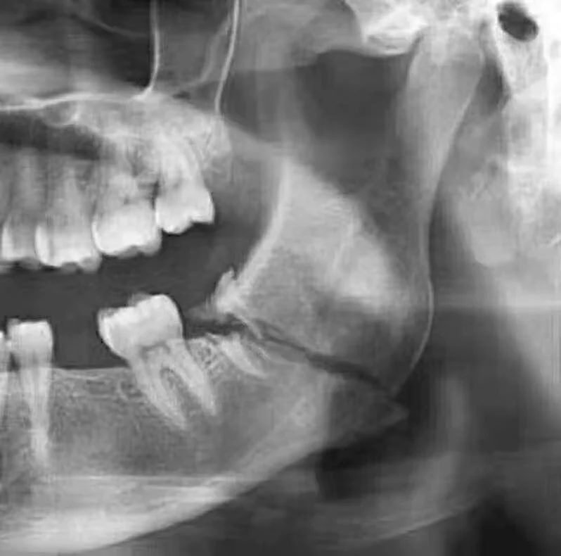 Medizinische Zahnklinik Krankenhaus Intra-Oral Portable Dental X Ray