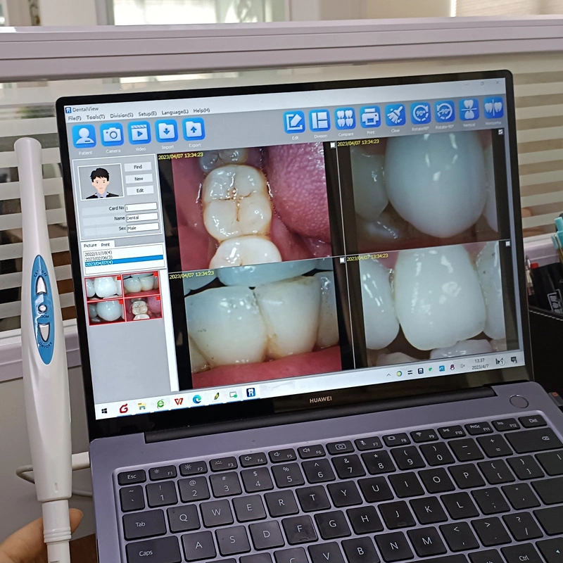 MD-930u 720p HD USB Dental Intraoral Camera Works with Computer