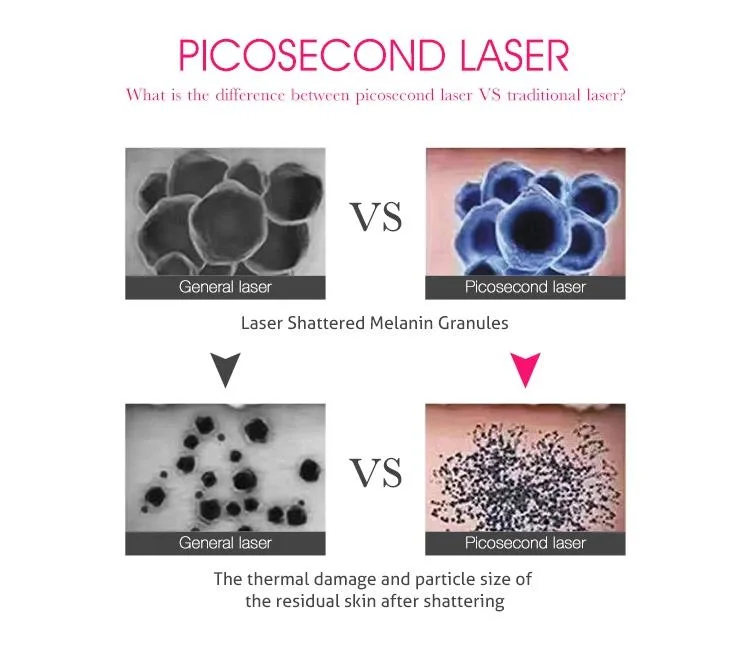 Picosecond Laser 1064 nm/532 nm/755 nm Qswitch Picosecond Laser Remoção de tatuagens em todas as cores Máquina