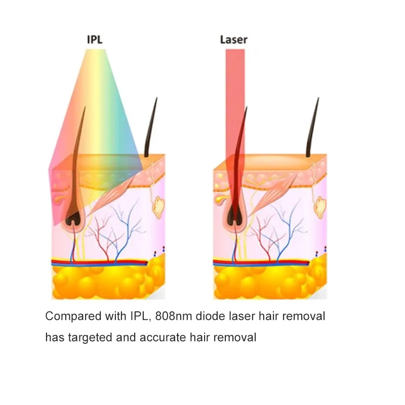 preço de fábrica Nova Tecnologia Máquina de remoção de pêlos a laser 808nm Laser de diodo de cuidados da pele da Máquina Salão de Beleza Máquina de Venda por grosso de equipamento de remoção de pêlos a laser