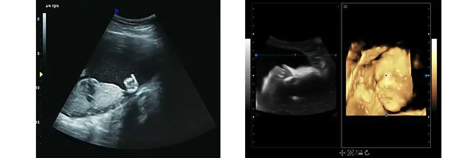 Ecografía Doppler Color Digital completa la máquina con el carro (THR-USC900)