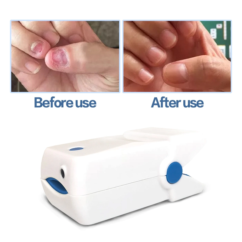 Lllt Fungal Nails Laser Therapy Device Nail Pilz-Infektion Behandlung Heimnutzung