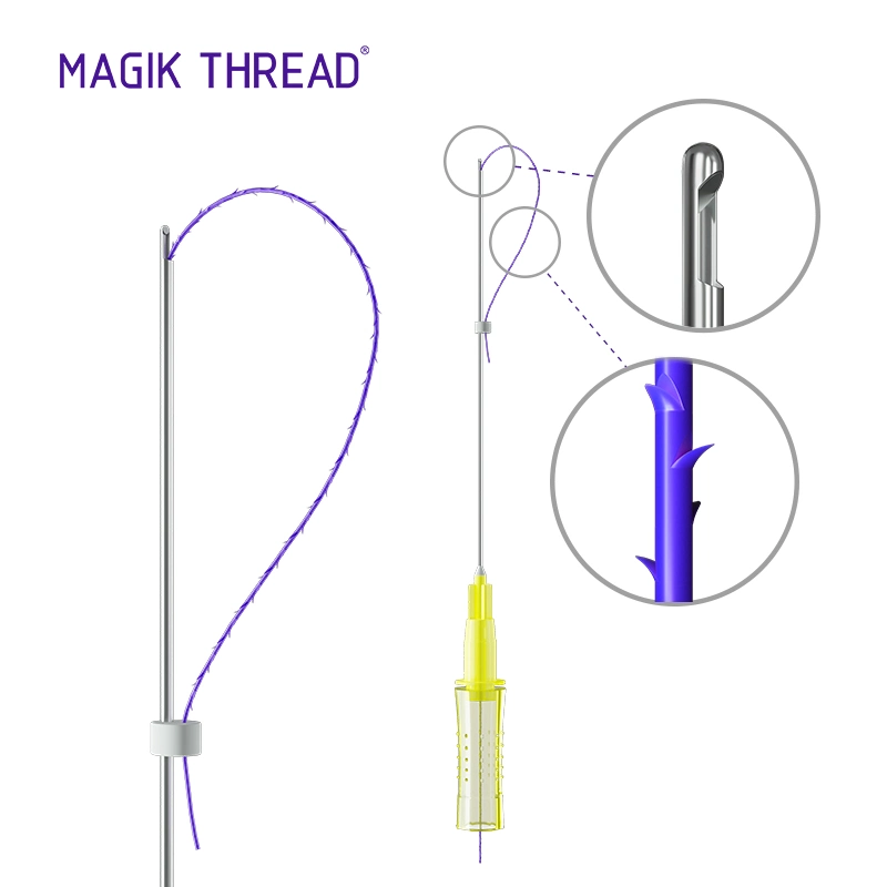 Magik Thread Disposable Medical Supplies Tear Trough Pdo Threads for Face Lifting