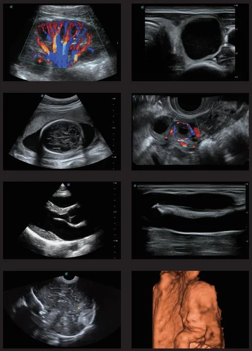 Sonoscape P15 4D Trolley Digital Color Doppler Ultrasound System for Obstetrics Gynecology Cardiovascular Urology