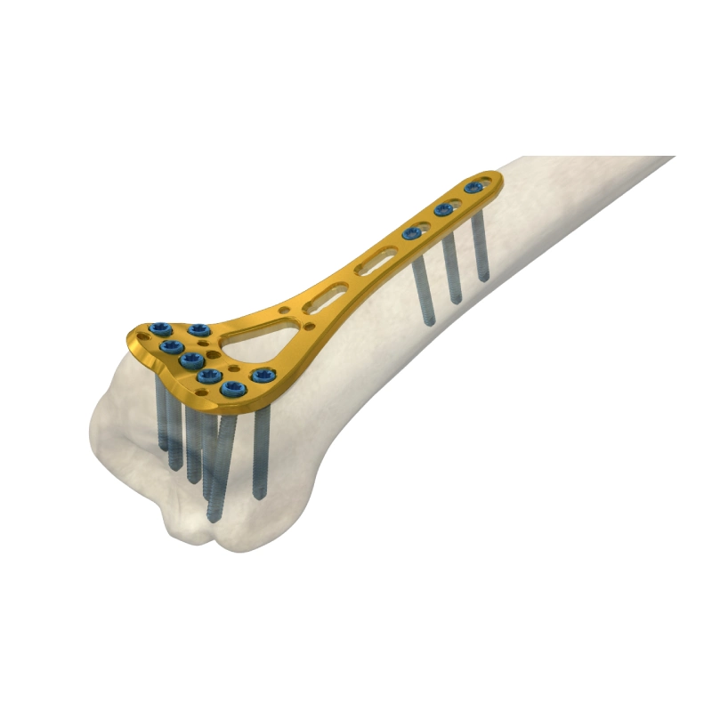 زراعة العظام التيتانيوم تقويم العظام 2.4 مم متغيرة الزاوية 2 عمود نصف قطر المسافة من لوحة LCP Bone، العرض 22 مم