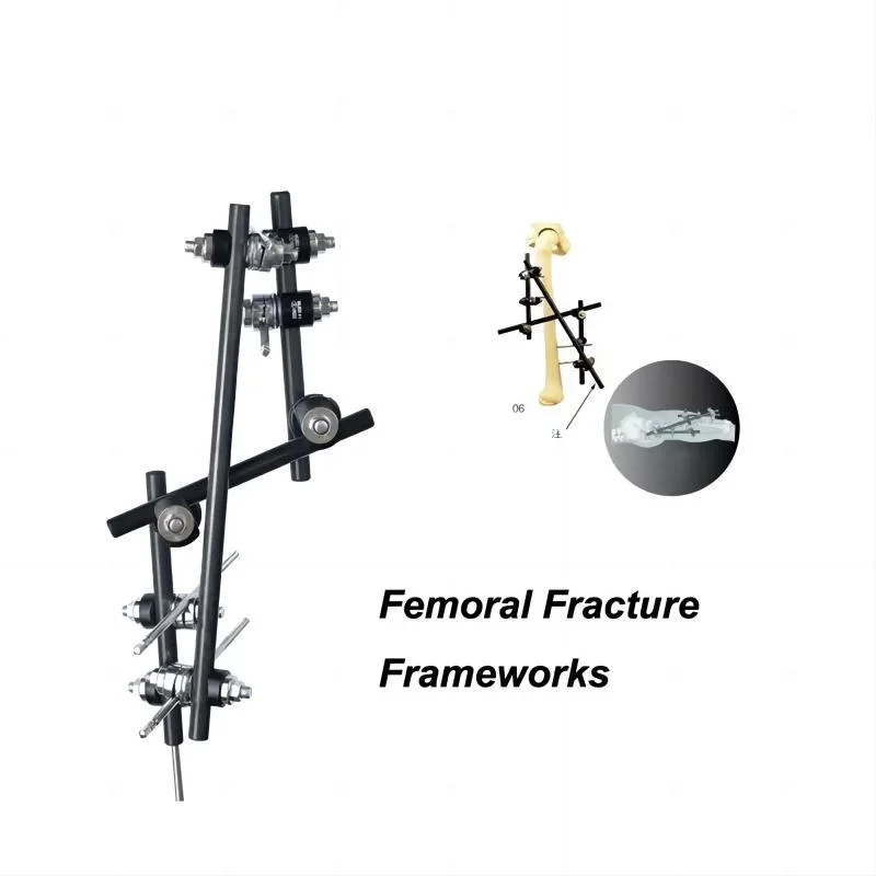 Orthopedic External Fixation Femur External Fixation