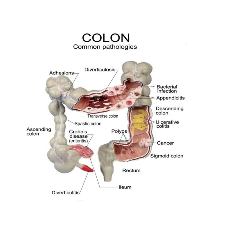 High quality/High cost performance  Medical Diseases Colon Model