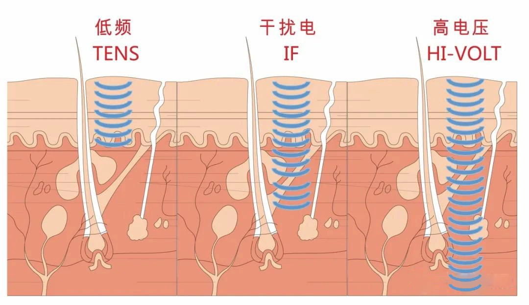 Decenas de baja frecuencia de la máquina de alivio del dolor Electroterapia Equipos de fisioterapia