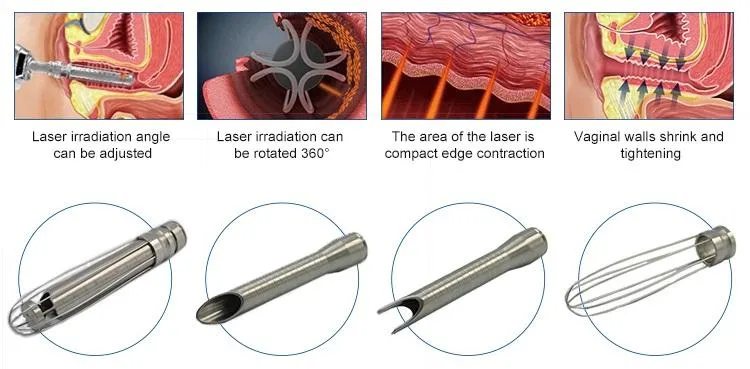 Hot Sales cicatrizes Remoção Beleza Máquina vaginal aperto CO2 Laser Máquina laser fracionada por CO2 de 10600 nm com returfacing para pele