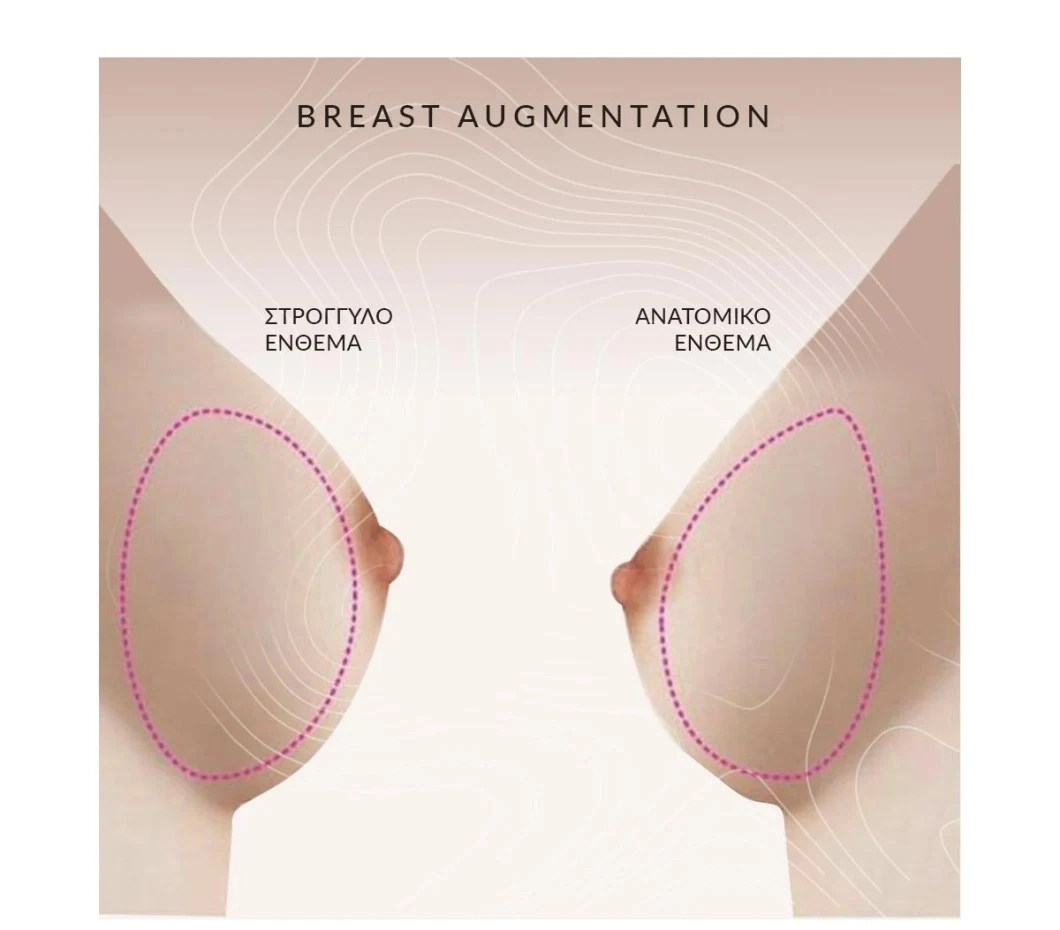 La cirugía plástica origen checo los implantes de mama con los Deline 100ML 100g implante inyectable Volumizing nalga Mama hialurónico mejora de la AICD relleno dérmico