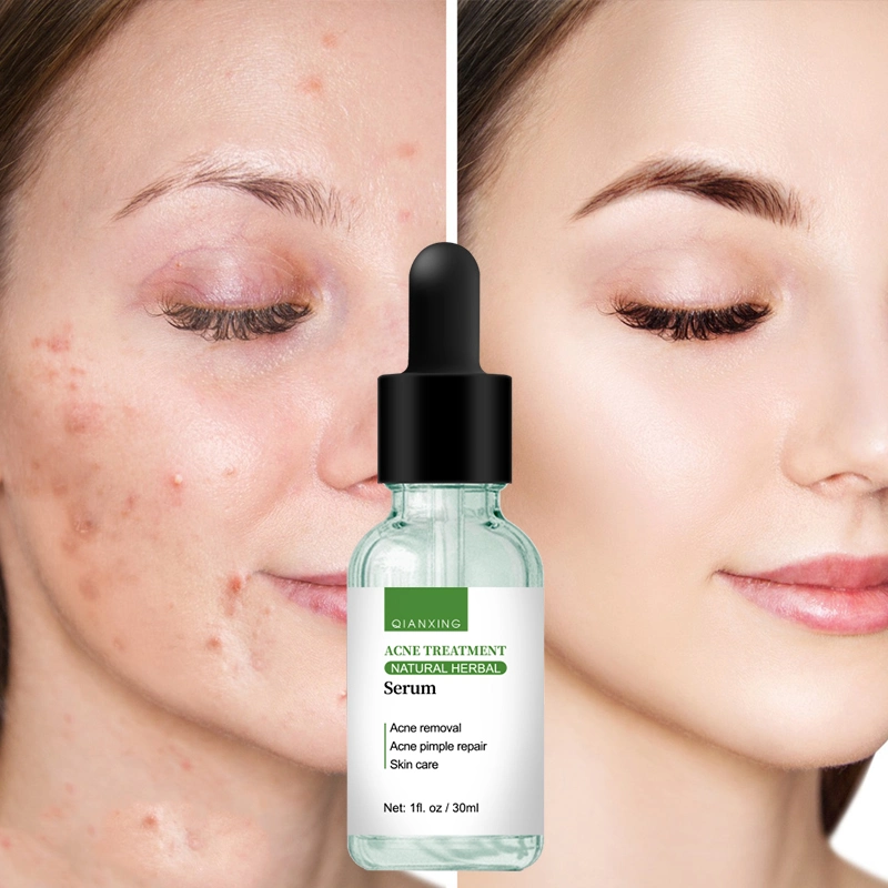 إزالة عالية الجودة علاج علاج مضاد Acne إصلاح علاج تجميل الوجه للبشرة