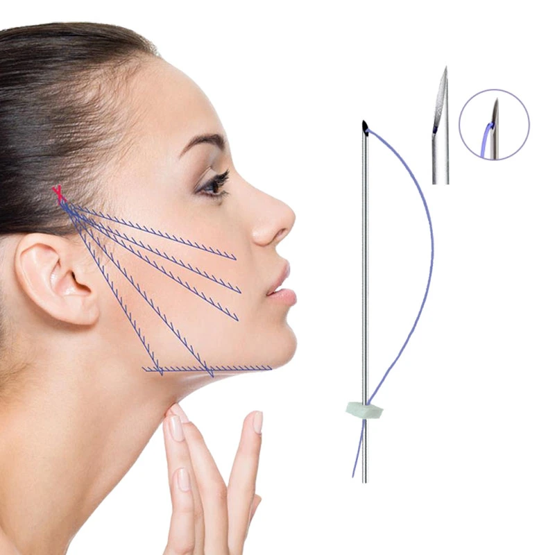 Cosmetic Curved Suture V Face Lift Hilos Tensores Lifting Pdo Mono Thread