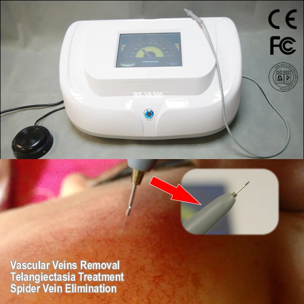 Hf Vascular Skin Tag Removal System