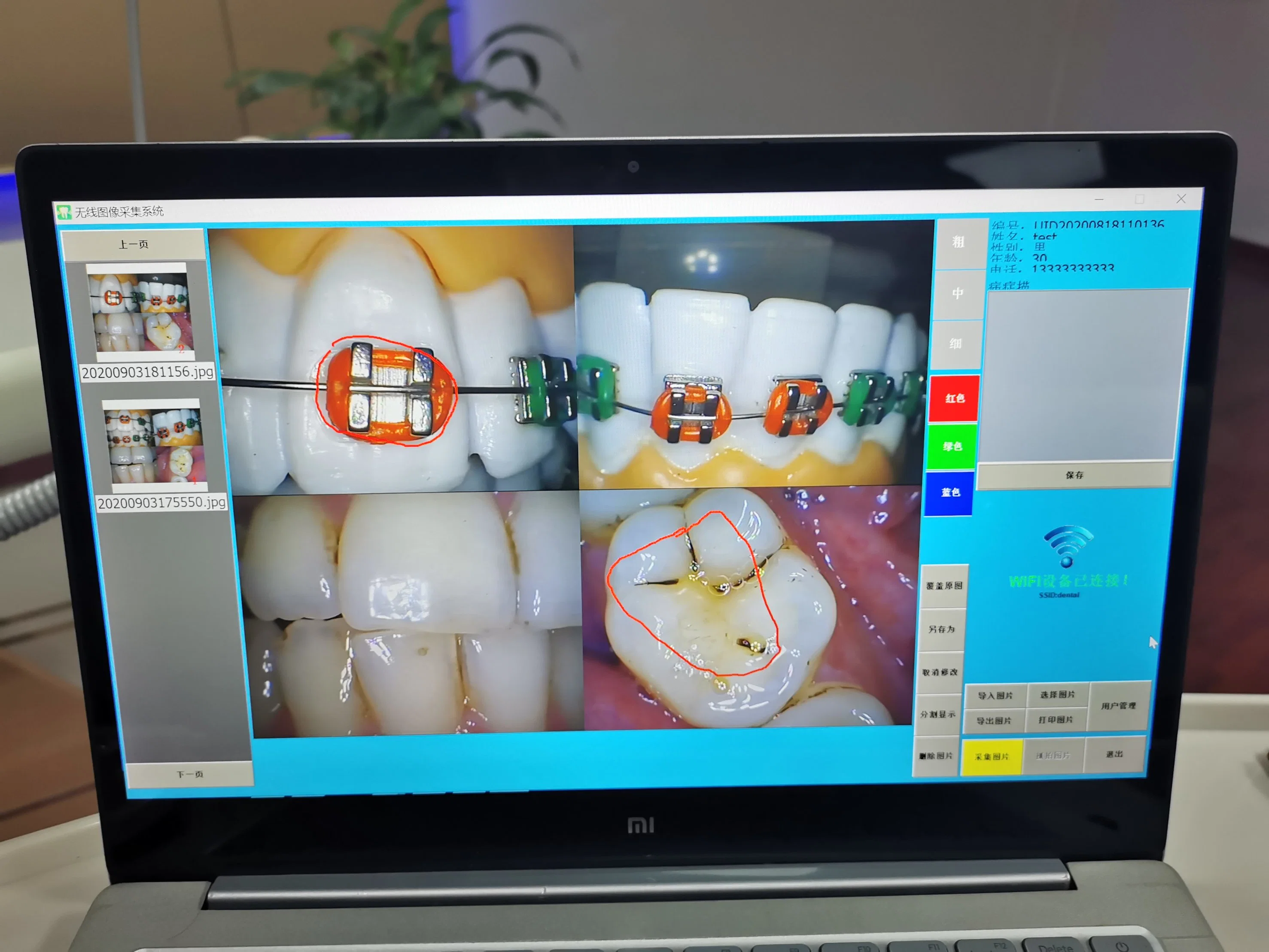 2020 dentro de la cámara HD Dental Oral de 21,5 pulgadas de pantalla de la Cámara Intraoral Dental