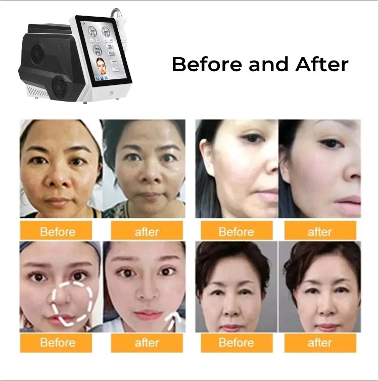 9d Ice Cooling Frozen Hifu Cryo 7D Hifu Machine Body Slimming Cryo Hifu Anti-Aging Skin Tightening Machine High Intensity Focused Ultrasound Frozen Hifu